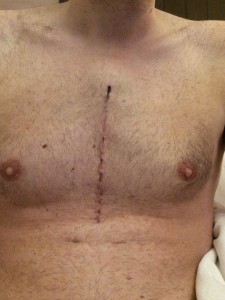 Heart surgery scar